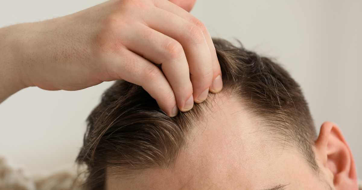 Alopecia de padrão defuso- o tratamento capilar é indicado?