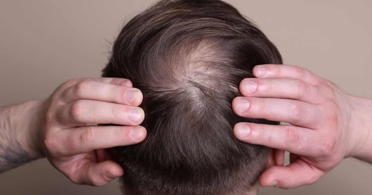 Dr eu preciso tomar algum remédio após o transplante capilar