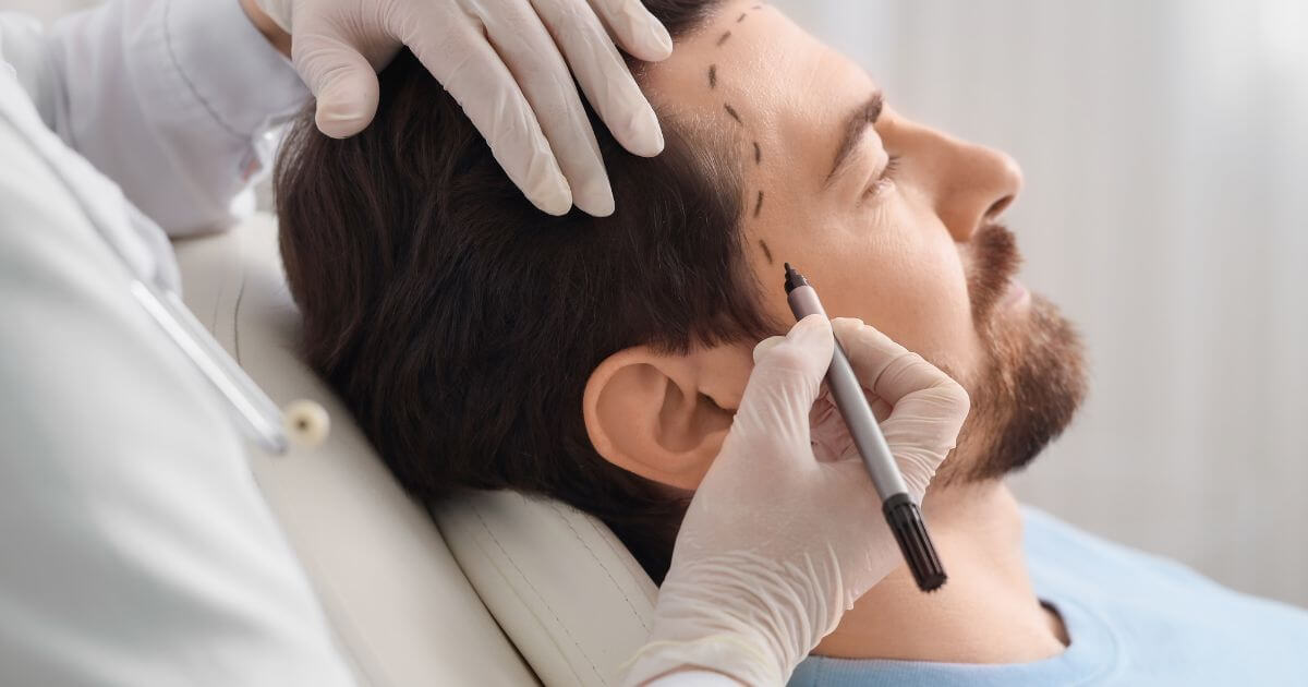 Quando se trata de transplante capilar, a naturalidade está nos detalhes