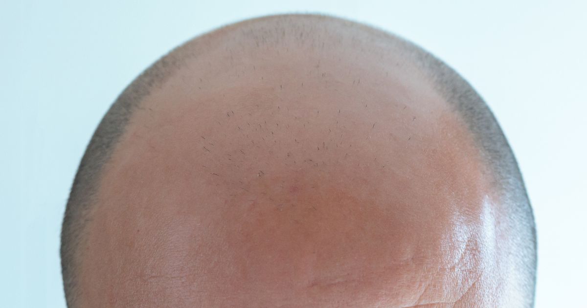 Da Calvicie a confiança- Reconstrução Capilar com naturalidade