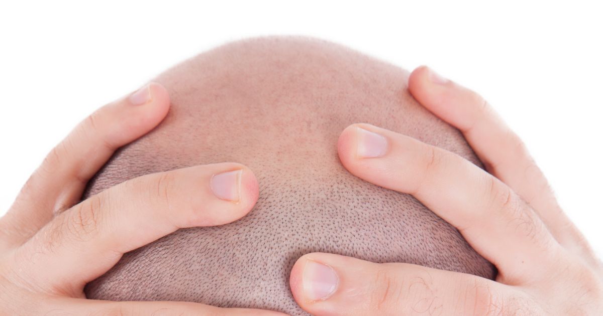 pós operatório transplante capilar cuidados