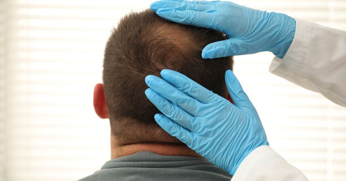 O resultado do transplante capilar começa muito antes da cirurgia